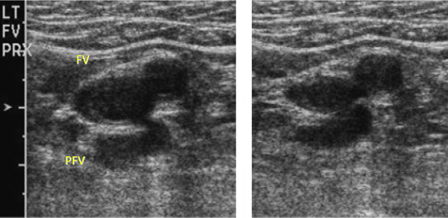 Deep vein thrombosis images