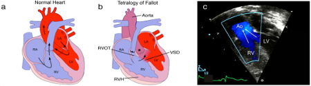 Tetralogy of Fallot images