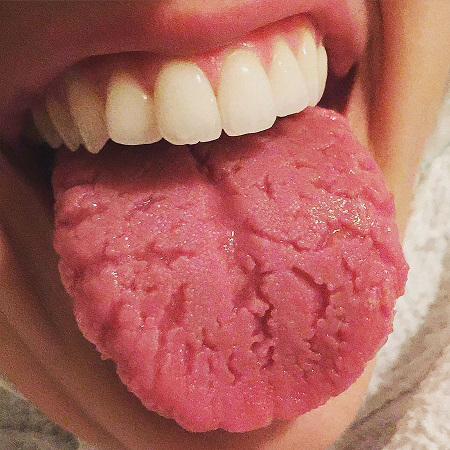 Fissured, hairy, and geographic tongue images