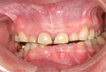磨牙症 images