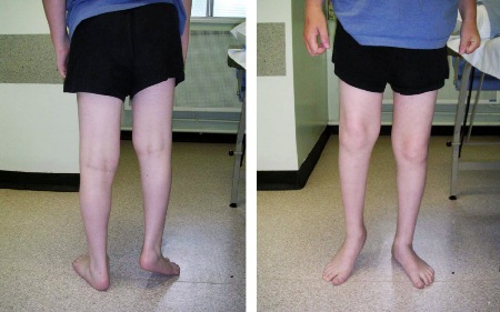 Evaluation of gait disorders in children - Etiology | BMJ Best Practice US