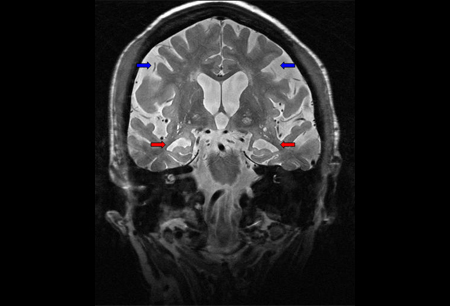 Assessment of memory deficit images