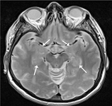 Evaluation of memory deficit