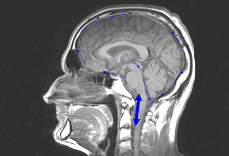 Hidrocefalia de pressão normal images