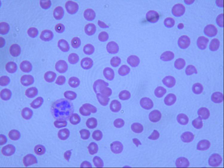Thrombotic thrombocytopenic purpura images