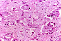原发性浸润性乳腺癌 images