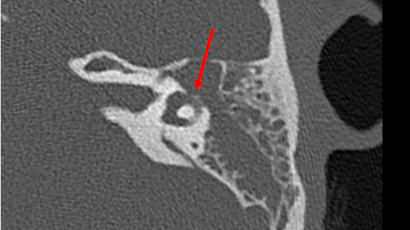 Labyrinthitis and vestibular neuritis images