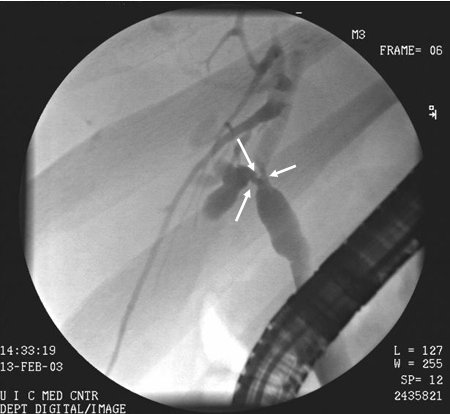 Cholangiocarcinoma images