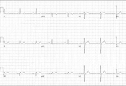 Atrioventricular block images