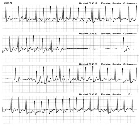 Atrioventricular block - Differentials | BMJ Best Practice