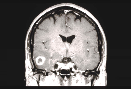 神经胶质瘤 images