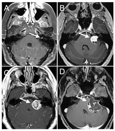 Vestibular schwannoma images