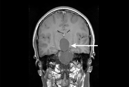 Craniopharyngioma images