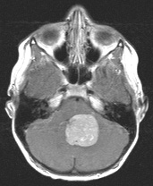 Meduloblastoma images