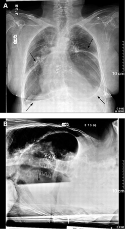 食管裂孔疝 images