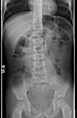 Faecal impaction with overflow