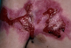 Epidermolysis bullosa images