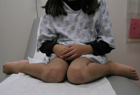 Torsion of the lower limb in children images