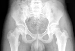Slipped capital femoral epiphysis images