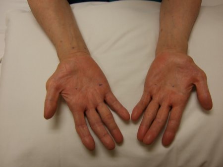 Evaluation of upper extremity mononeuropathy images
