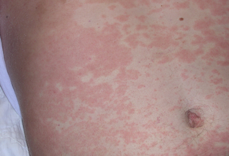 Viral Que Es Exantema Maculopapular tendencias Viral Que Es Exantema Maculopapular tendencias