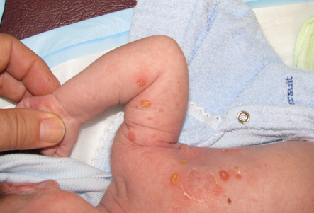 Assessment of pustular rash images