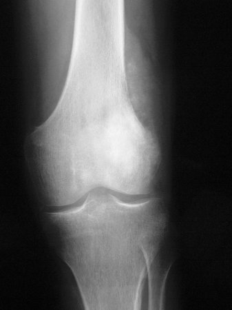 Osteosarcoma images