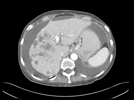 Adenocarcinoma of unknown primary site images