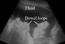 Spontaneous bacterial peritonitis images