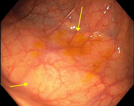 Colorectal polyps images