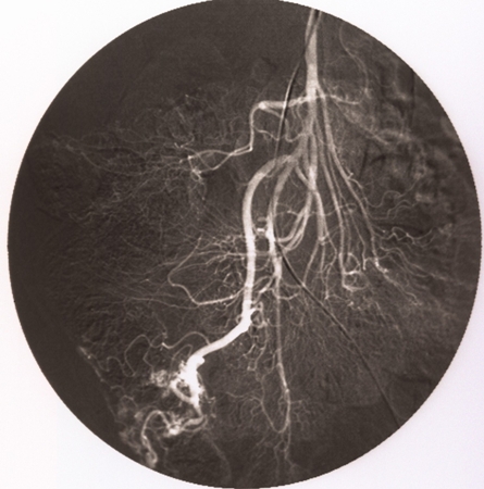 Angiodysplasia Of The Colon - Symptoms, Diagnosis And Treatment | BMJ ...