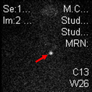 Subacute thyroiditis images