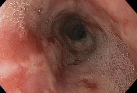 Gastro-oesophageal reflux disease images