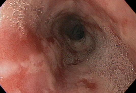 Gastroesophageal reflux disease images