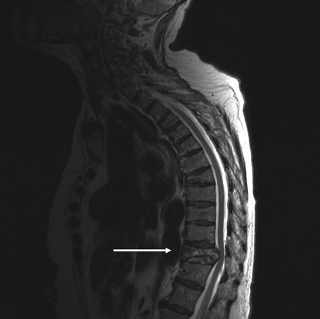 Thoracolumbar spine trauma images