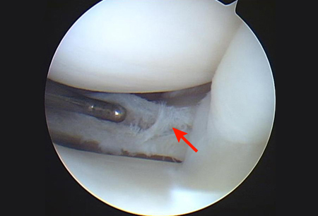 Meniscal tear images