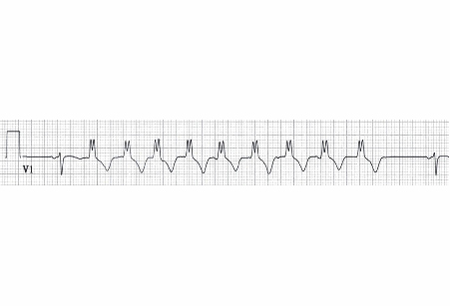 Non-sustained ventricular tachycardias images