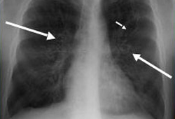 Aspergilose broncopulmonar alérgica images