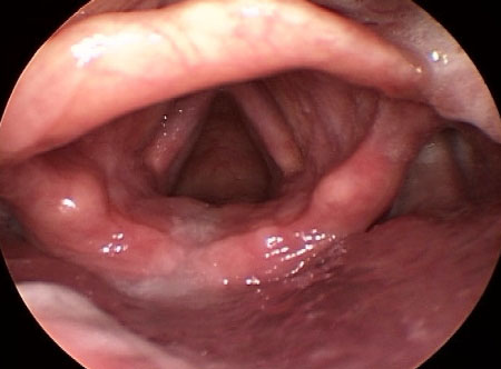 Assessment of hoarseness and dysphonia images