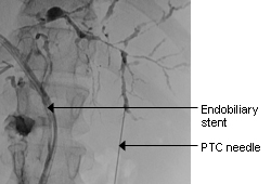 Primary sclerosing cholangitis images