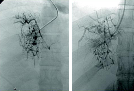 Budd-Chiari syndrome images