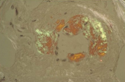 Evaluación de la proteinuria images