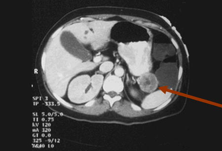 血管活性肠肽瘤 images
