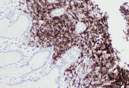 Linfoma de tecido linfoide associado à mucosa (MALT) images