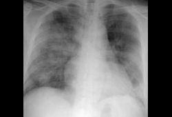 Severe acute respiratory syndrome (SARS) images