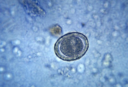 Ascariasis images