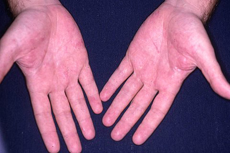 Dyshidrotic Dermatitis - Symptoms, Diagnosis And Treatment | BMJ Best ...