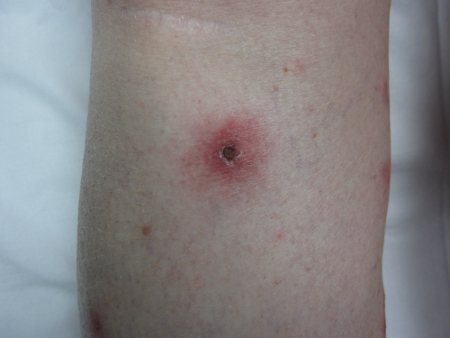 Ehrlichiosis and anaplasmosis images