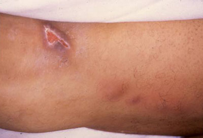 Tularemia images