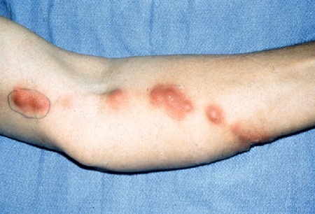 Sporotrichosis images